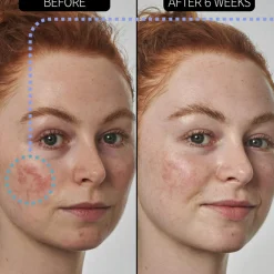 Azelaic Acid 10% Serum