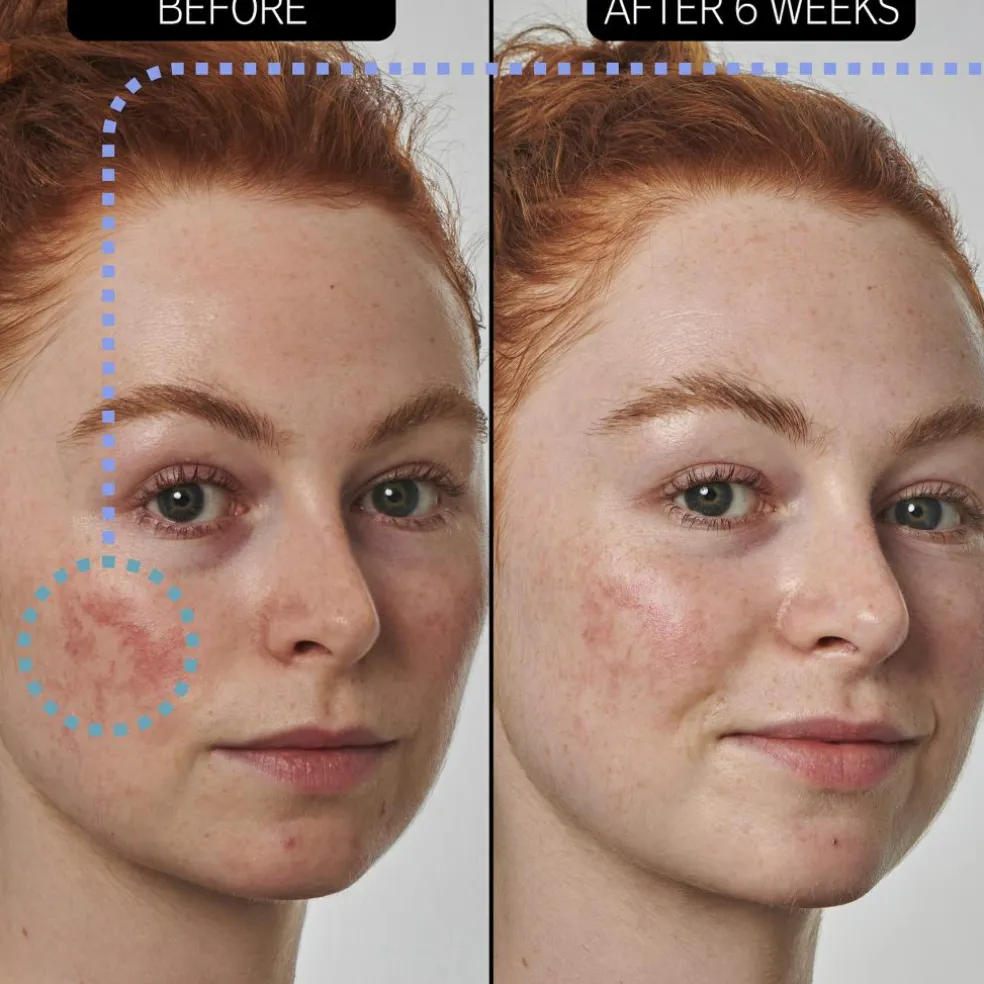 Azelaic Acid 10% Serum