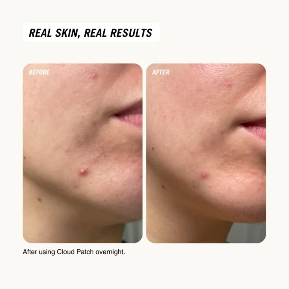 Cloud Patch Centella Spot Care