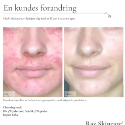 Hh 3*Hyaluronic Acid 3*Peptides