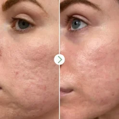 Hyaluronic Acid 0.3%