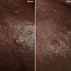 Invisible Pimple Patches