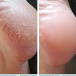 Pakke til Hård Hud på Hælen og Fødderne