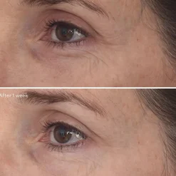 Retinal Resculpt Eye Treatment