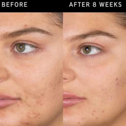 Salicylic Acid Cleanser