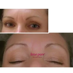 WrinkleEraser Basic Kit